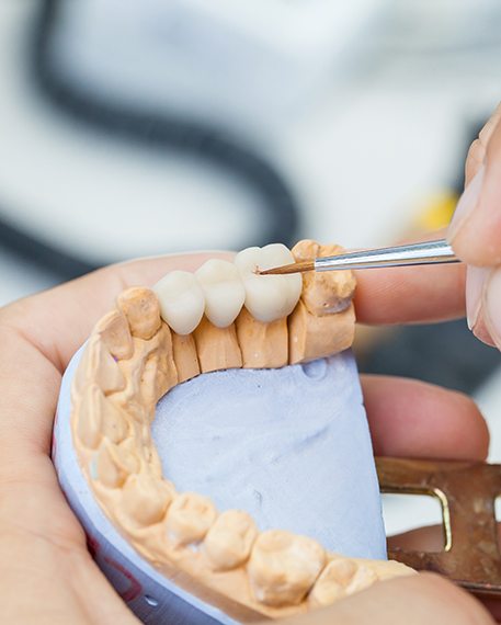 Dental bridge on a cast being created