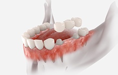 Rendering of dental bridge levitating over lower arch that’s translucent with white background