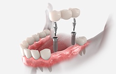 Rendering of implant bridge in lower arch with translucent jaw and white background