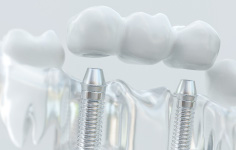 Model of a dental implant