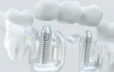 Example of a dental implant bridge in Parsippany