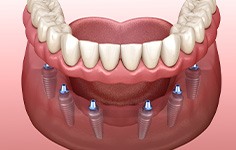 Example of implant dentures in Parsippany