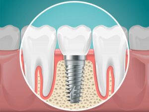 illustration of a dental implant 